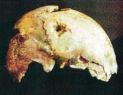Fragmento do crânio de Hitler com buraco da bala.